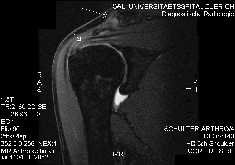MRI._Subacromial_impingement.