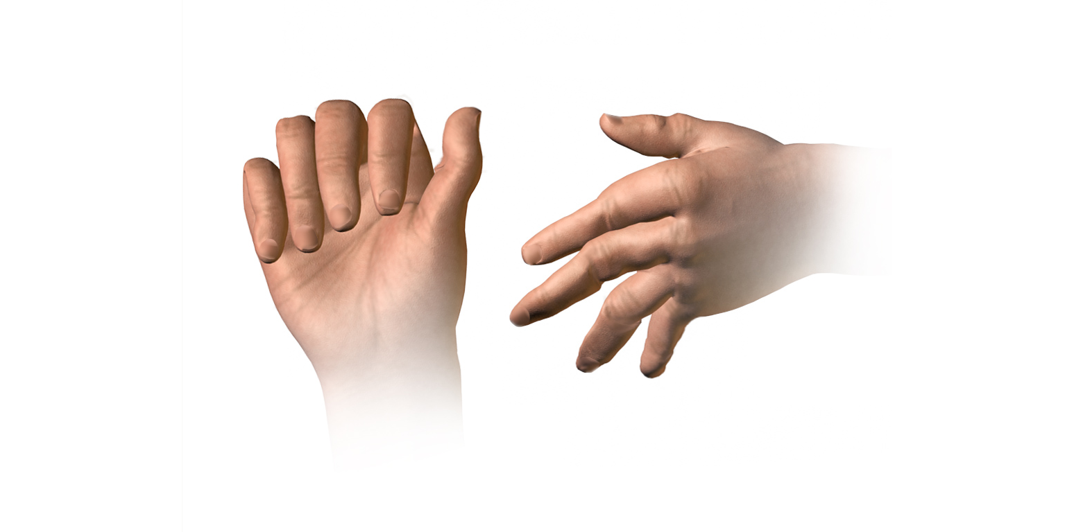 Rheumatoid_Arthritis_(Swan_Neck_Deformity)