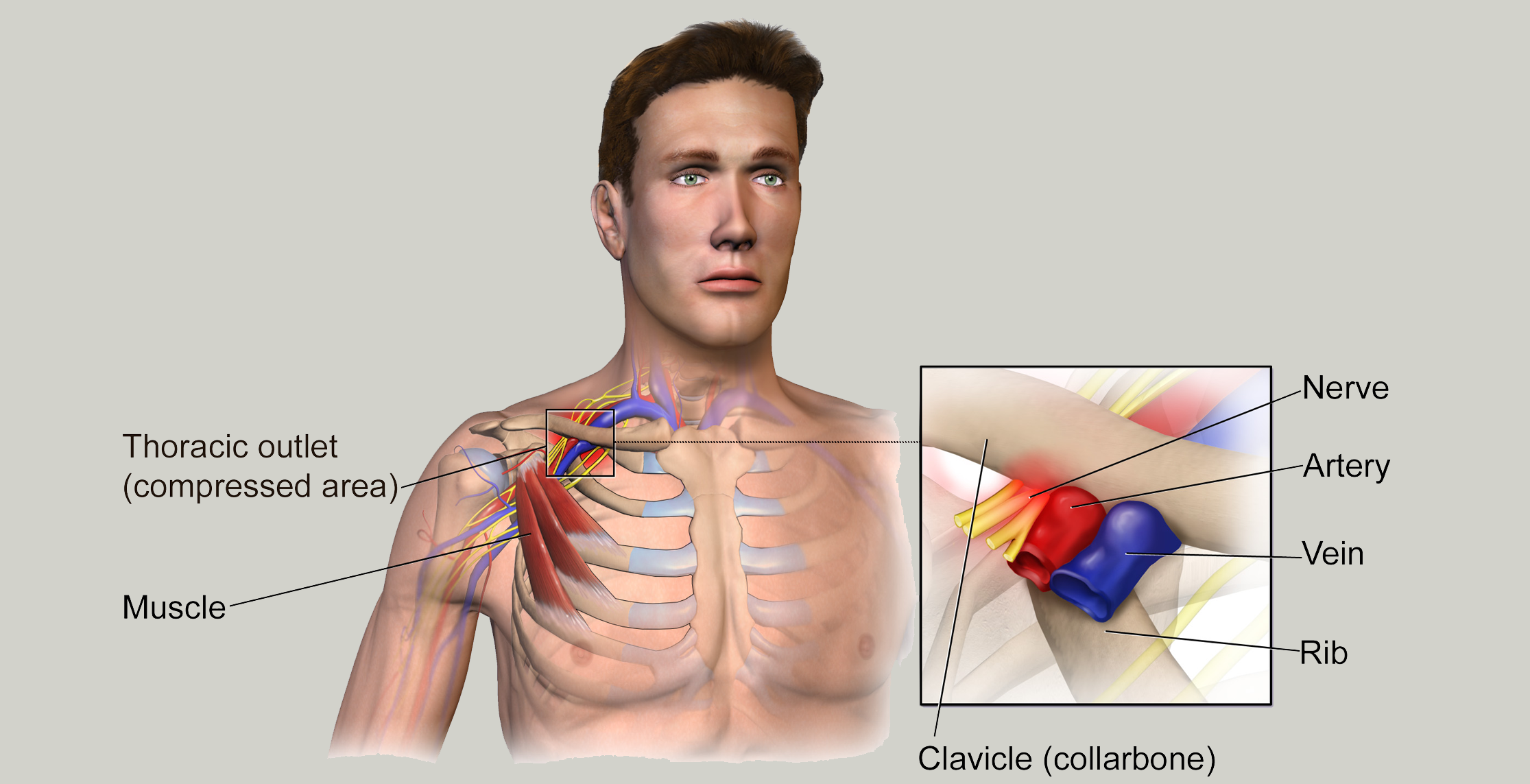 Thoracic_Outlet_Syndrome